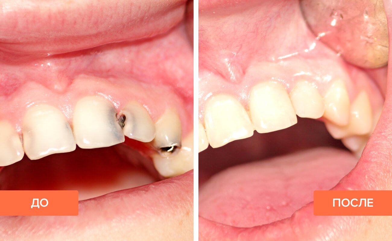 лечение кариеса зубов москва