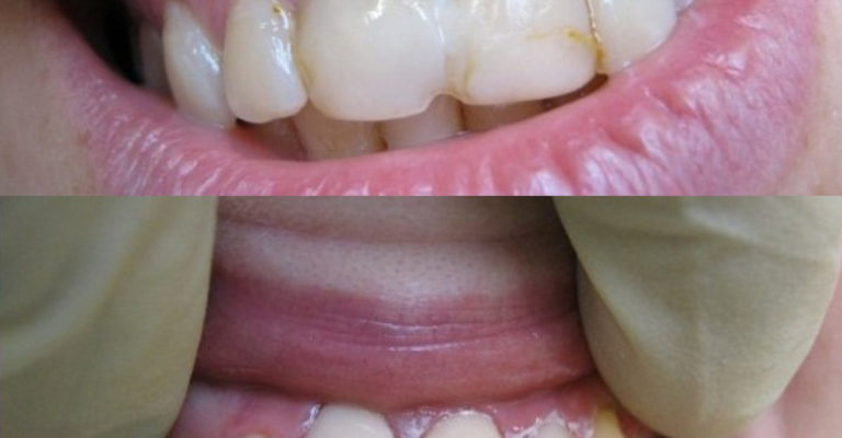 Лечение кариеса фронтальных зубов
