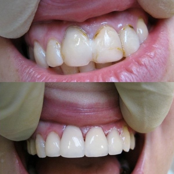 стоматология лечение кариеса