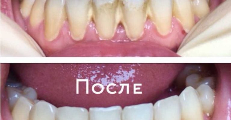 профессиональная гигиена полости рта и зубов