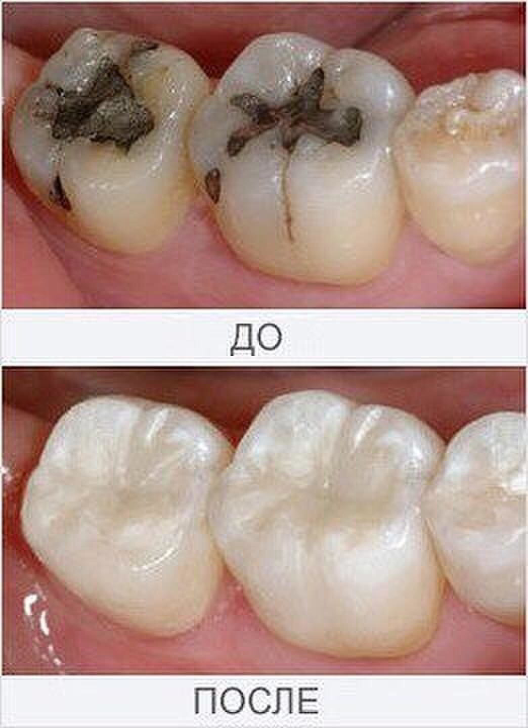 лечение кариеса зубов москва