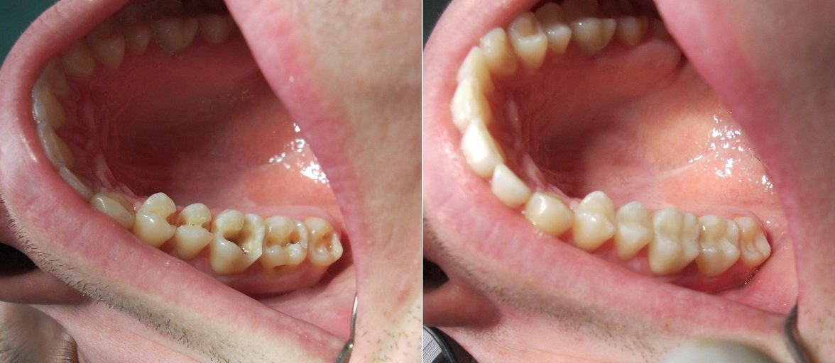 стоматология лечение кариеса