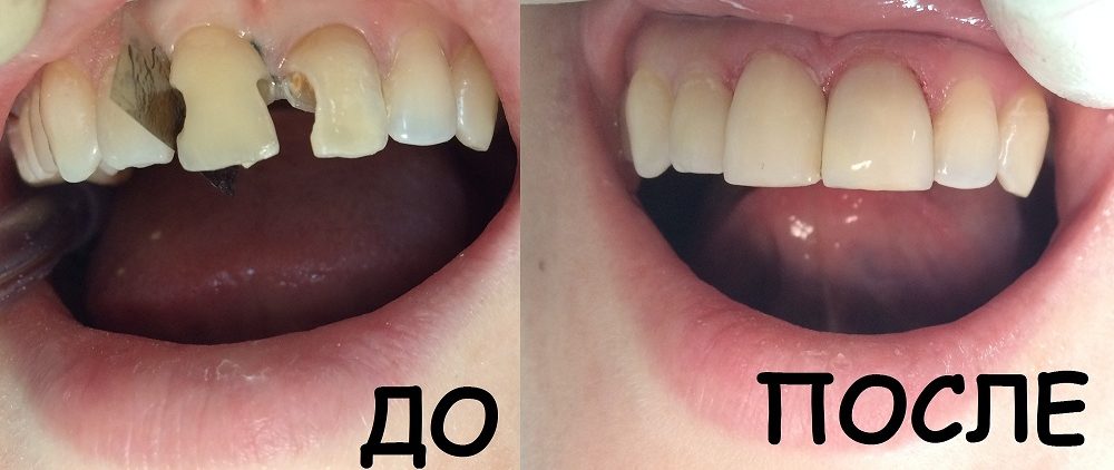 стоматология лечение кариеса цена
