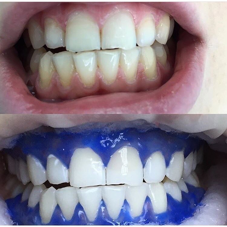 профессиональное отбеливание зубов amazing white клиническое отбеливание
